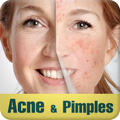 ”Acne & Pimples