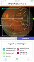 ATLAS Retinopatía Diabética ảnh chụp màn hình 1