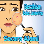 Resep Manjur Hilangkan Bekas Jerawat