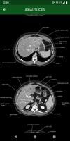 abdominal CT: annotated slices ảnh chụp màn hình 2
