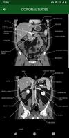 abdominal CT: annotated slices ảnh chụp màn hình 3