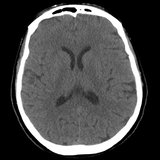 Brain CT : annotated slices