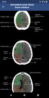 Brain CT : annotated slices স্ক্রিনশট 2