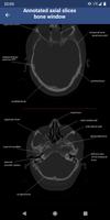 Brain CT : annotated slices স্ক্রিনশট 3