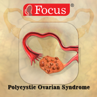 Polycystic Ovarian Syndrome أيقونة
