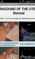 Gynecology Ultrasound ảnh chụp màn hình 1