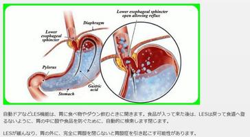 برنامه‌نما ورم معده، سوزش سردل، GERD عکس از صفحه