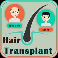 Hair Transplant Affiche