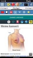 Meme kanseri Ekran Görüntüsü 1