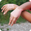 vitiligo medicina natural