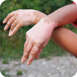 vitiligo medicina natural simgesi