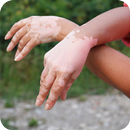 vitiligo medicina natural APK