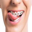 Cleaning Tips with Braces