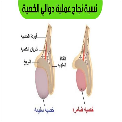 الخصية اسباب دوالي دوالي الخصية