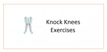 Knock Knees Exercises