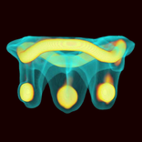 ViV Mitral