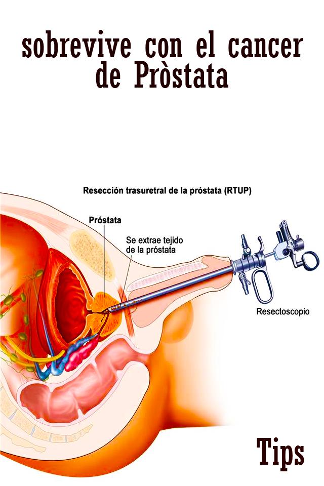 remedios alternativos para el agrandamiento de la próstata