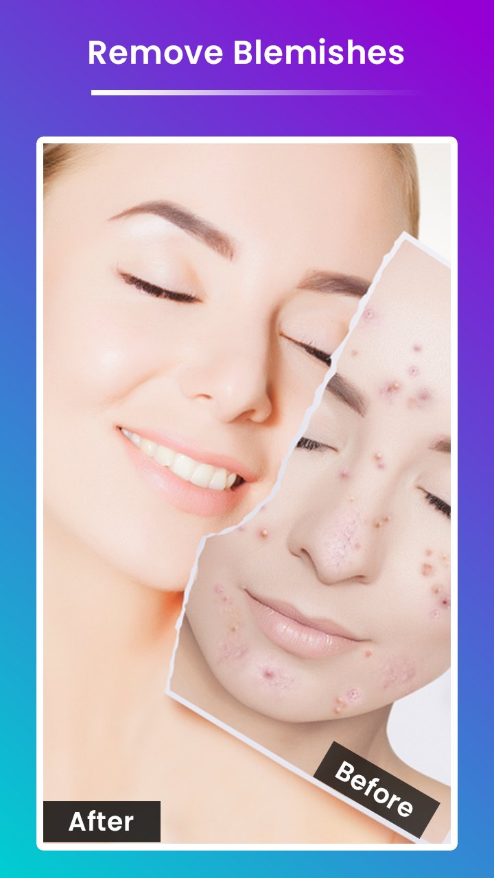 Pimples Remover App Remove Blemish & Acne APK للاندرويد تنزيل