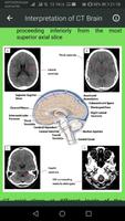 Brain CT Scan Interpretation Affiche