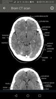 CT Scan of Brain capture d'écran 3