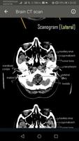 CT Scan of Brain capture d'écran 1