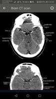 CT Scan of Brain capture d'écran 2