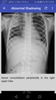 Chest X-Ray capture d'écran 3