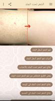 الشعر تحت الجلد وعلاجه poster