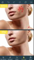 Photo Retouch-Pimple Eraser ภาพหน้าจอ 1