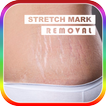 Tips Mengobati Stretch Mark