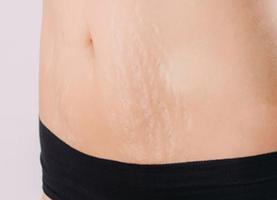 Tips Mengobati Stretch Mark Ekran Görüntüsü 1