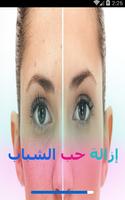 إزالة حب الشباب و آثاره طبيعيا 截图 3