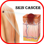 皮肤癌