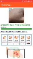 DermoApp: Skincancer detection Screenshot 2