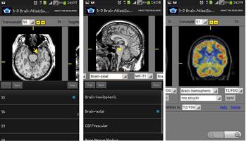 3-D brain Atlas 海报