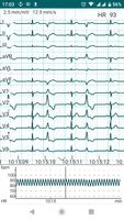 DiaCard - ECG Recorder capture d'écran 3