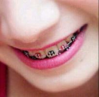 Braces اسکرین شاٹ 3