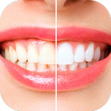 teeth whitening aplikacja