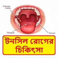 টনসিল রোগের চিকিৎসা ~ Tonsil Disease Treatment APK download