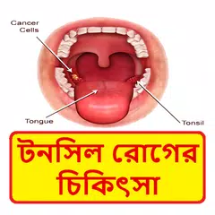 টনসিল রোগের চিকিৎসা ~ Tonsil Disease Treatment APK 下載