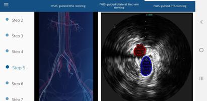 Philips Venous IVUS Tutor ảnh chụp màn hình 2
