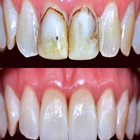 Icona طرق علاج تسوس الاسنان