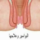 طريقة علاج البواسير في المنزل ícone