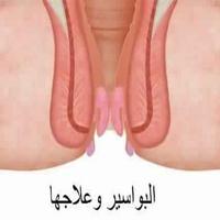 طريقة علاج البواسير في المنزل 포스터