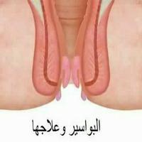 طريقة علاج البواسير في المنزل 스크린샷 1