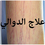 كيفية علاج الدوالي