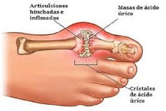 Tips Pain Uric Acid Drop For Android Apk Download