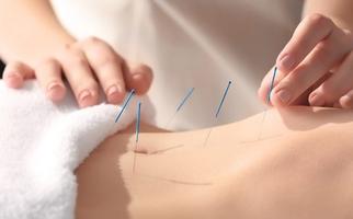 Acupuncture et avantages Techniques d'acupuncture Affiche