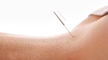 Acupuncture Affiche