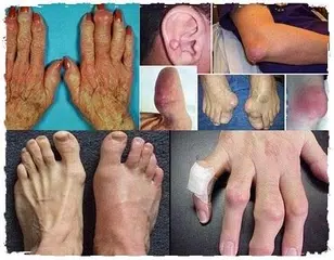 download Home rimedi gotta dell'acido urico APK